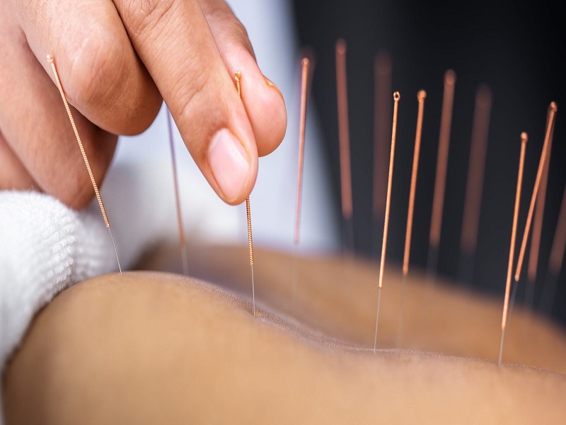Accupuncture